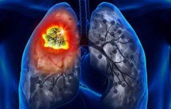 أبرزها السعال المستمر.. 5 علامات تخبرك بإصابتك بسرطان الرئة