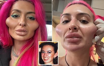 امرأة تخضع لعدة عمليات تجميل لتصبح صاحبة أكبر وجنتين