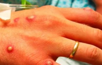 خبراء يوجهون نصائح هامة لمخالطي مرضى جدري القرود