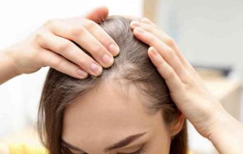 أمريكا: الموافقة على أول دواء عبر الفم لعلاج الثعلبة