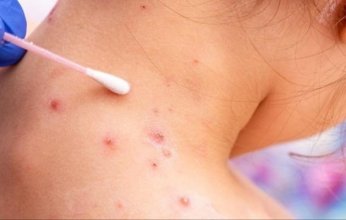 بريطانيا: إجراء أول تجربة سريرية في العالم لتقييم عقار مضاد لجدري القرود