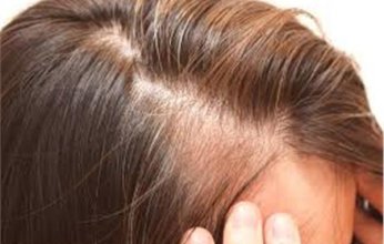 علاج جديد يعالج "الثعلبة" ويعيد أكثر من 80% من الشعر