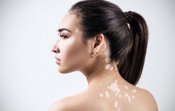 اضطرابات جهاز المناعة تسبب البهاق