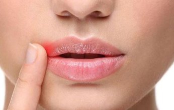 لمنع الإصابة بقرح البرد.. إليك الأسباب والعلاج