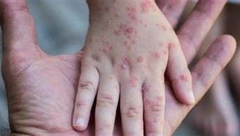 الصحة المغربية تعلن تسجل حالة إصابة مؤكدة بفيروس جدري القردة لوافد أجنبي