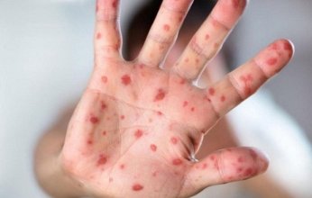 الولايات المتحدة تعلن جدري القرود حالة طوارئ صحية عامة