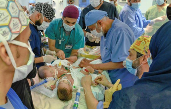 المملكة تتوج ريادتها العالمية في فصل التوائم السيامية بالعملية الجراحية رقم 52