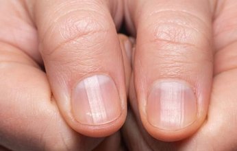 تعرف على علامات بأظافرك تكشف إصابتك بالسكري
