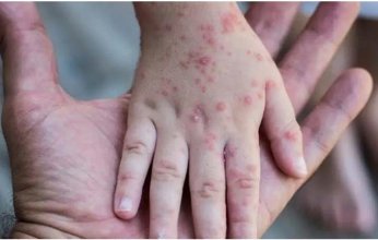 الصحة الأردنية تعلن تسجيل أول حالة إصابة بجدرى القردة