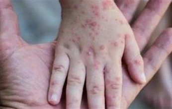 عاجل.. الصحة المصرية تعلن اكتشاف أول حالة مصابة بجدري القرود