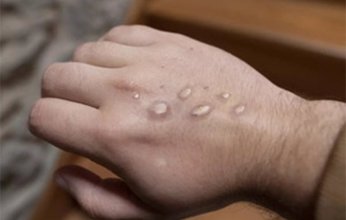 الصين توجه نصيحة لرعاياها لتجنب جدري القرود