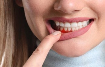 دراسة تحذر: عدوى بسيطة في اللثة يمكن أن تسبب مرض قلبي