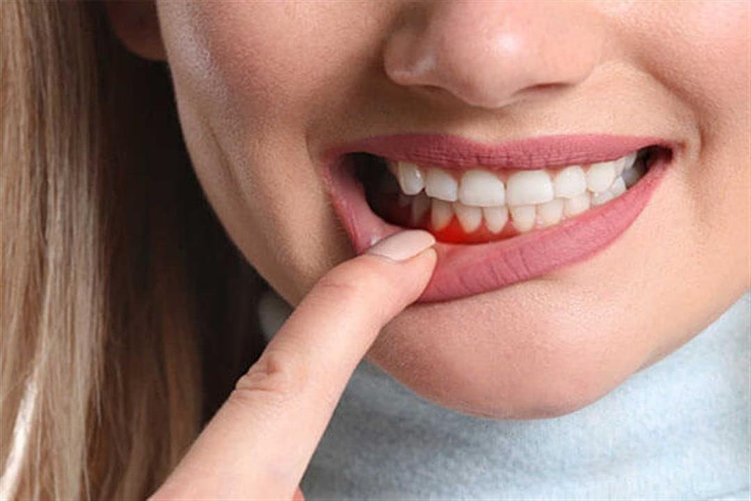 علاج نزيف اللثة بالمواد الطبيعية علاج نزيف اللثة بالمواد الطبيعية