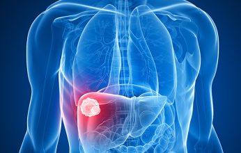 دراسة دولية تتوقع وفاة 3ر1 مليون بسبب سرطان الكبد في 2040