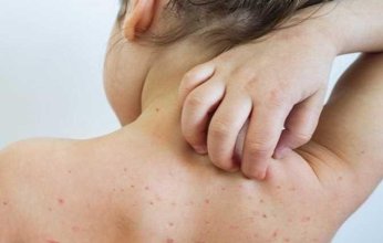 الصحة المصرية تعلن إيجابية حالة إصابة جديدة بفيروس جدري القرود