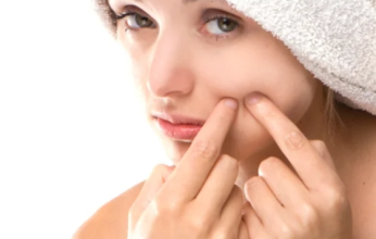 حب الشباب الهرموني.. ماهي اسبابه وعلاجه وخطورته؟