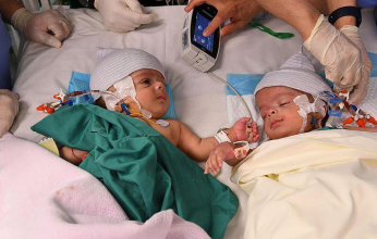 نجاح عملية فصل التوأم السيامي اليمني "سلمان وعبد الله"