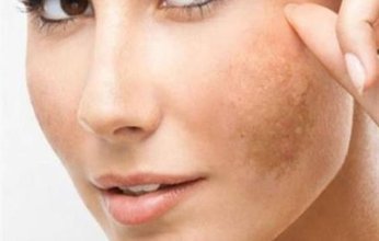احذرى اشعة الشمس تسبب التهاب الجلد وظهور البقع