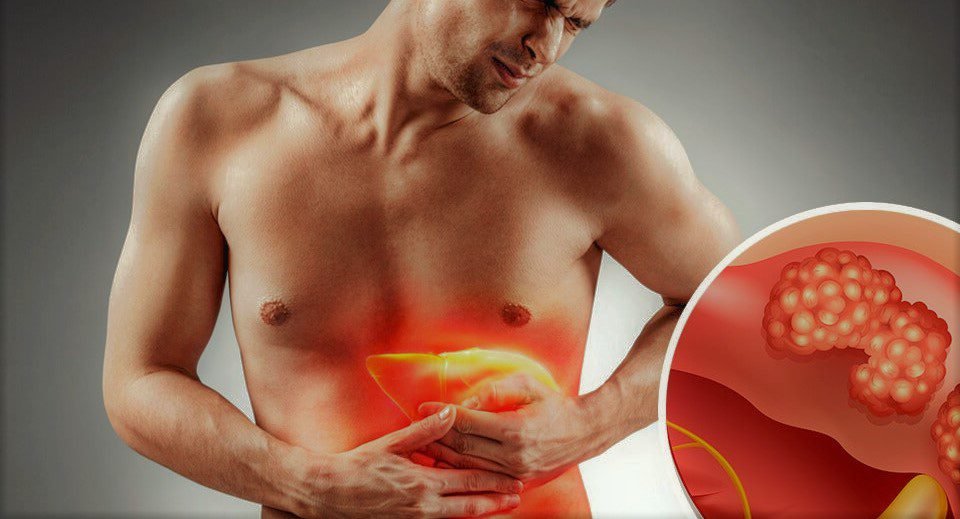علماء يكشفون عن نهج جديد لعلاج سرطان الكبد علماء يكشفون عن نهج جديد لعلاج سرطان الكبد