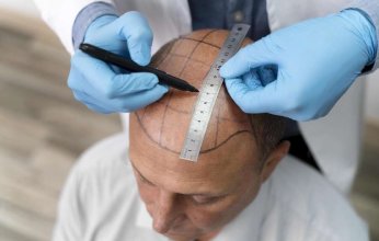 طرق علاج تساقط الشعر للرجال بعد سن الأربعين