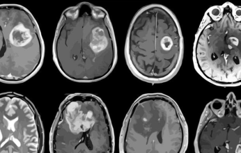 يستخدم فى الطب الصينى التقليدى.. ابتكار دواء جديد لعلاج سرطان المخ