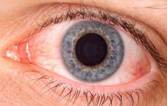 بالتفاصيل.. كل ما تريد معرفته عن المتحور الجديد «أركتوروس» وأعراضه