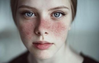 نصائح للتعامل مع حروق الشمس بشكل صحيح.. فما هي؟
