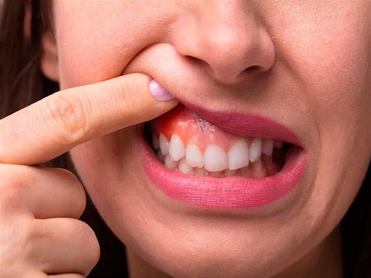 كل ما تريد معرفته عن مشكلة انحسار اللثة كل ما تريد معرفته عن مشكلة انحسار اللثة