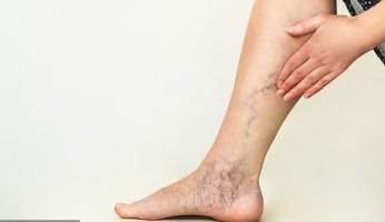 هل السيدات أكثر عرضة للإصابة بدوالى الساقين.. ولماذا؟