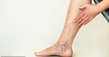 هل السيدات أكثر عرضة للإصابة بدوالى الساقين.. ولماذا؟ هل السيدات أكثر عرضة للإصابة بدوالى الساقين.. ولماذا؟