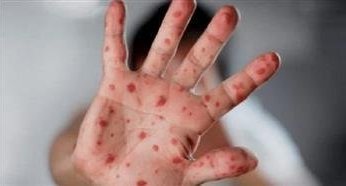 كوريا الجنوبية.. تسجيل 5 حالات إصابة جديدة بجدري القردة