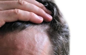 بالتفاصيل.. خطوات للتخلص من فطريات الرأس المزعجة