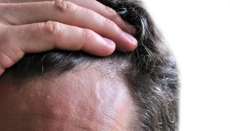 بالتفاصيل.. خطوات للتخلص من فطريات الرأس المزعجة بالتفاصيل.. خطوات للتخلص من فطريات الرأس المزعجة