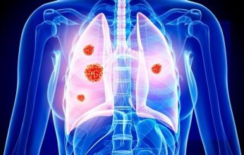 دراسة سريرية تكشف عن علاج جديد لسرطان الرئة ينهي عصر الكيماوي