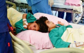 فريق طبي سعودي ينجح في فصل التوأم السيامي المصري «سلمى وسارة»