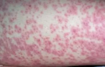 مرض نادر يثير القلق في استرالية.. ماذا تعرف عن «المكورات السحائية»؟