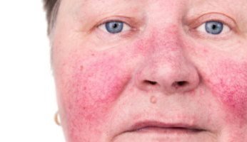 بالتفاصيل.. كل ما تريد معرفته عن مرض الوردية الجلدية