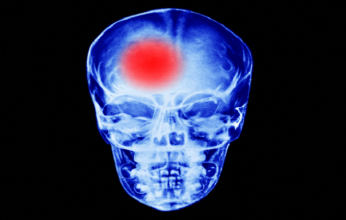 أطعمة تعزز خطر الإصابة بالسكتة الدماغية.. تعرف عليها