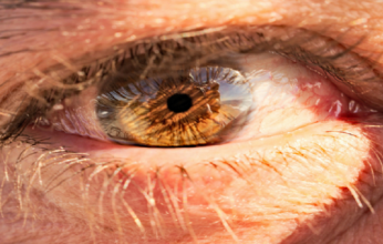 علماء يكتشفون طريقة لتحديد الأعراض المبكرة للخرف في العينين