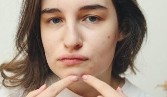 هل للهرمونات دورًا فى تكوين حب الشباب.. وما هي إجراءات العلاج؟
