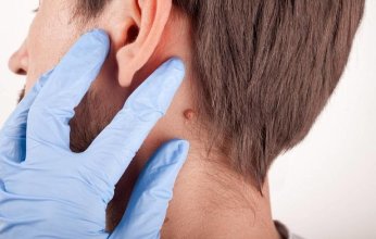 كل ما تريد معرفته عن الزوائد الجلدية.. أسباب ظهورها وطرق علاجها