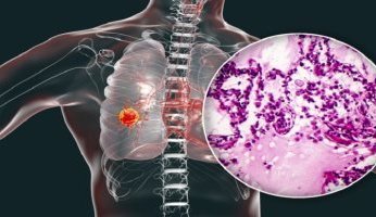 تقارير تكشف أهمية ممارسة التمارين الرياضية في تحسن الحالة الصحية لمرضى سرطان الرئة