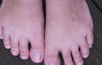 دراسة تكشف عن عارضا غريبا وجديدا لـ«كورونا طويل الأمد»