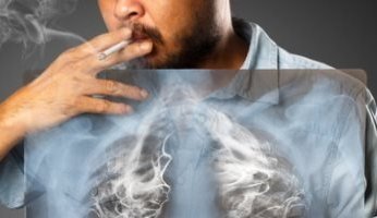 بالتفاصيل.. كل ما تريد معرفته عن سرطان الرئة أسبابه وعوامل الخطر