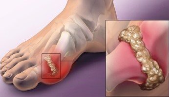 بالتفاصيل.. أعراض وأسباب وطرق علاج مرض النقرس