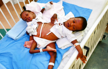 غدًا.. إجراء عملية فصل التوأم السيامي التنزاني "حسن وحسين"