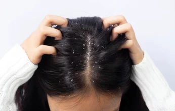 طرق طبيعية لعلاج قشرة الشعر في الشتاء
