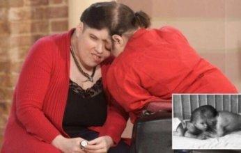 وفاة أكبر توأم ملتصق في العالم