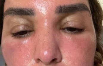 ضربة شمس تغير ملامح فنانة مصرية بشكل كامل