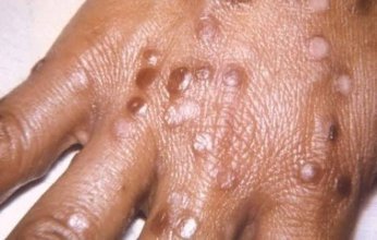 «جدري القرود» يرعب العالم بعد اكتشاف حالة في السويد